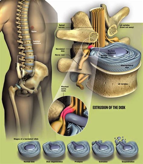 Bahagian luar keras dan dipanggil annulus. jihajumi: RAWATAN SLIP DISC