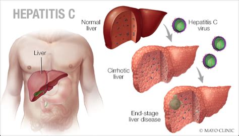 Monteagle fire & rescue to: Grundy County Health Department to offer Hepatitis C testing