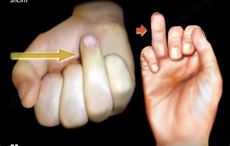 During grip ring fingertip is 5 mm more prominent than other digits in ~90% of patients. The Jersey Finger — OrthopaedicPrinciples.com
