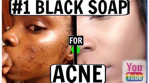 Good reasons to choose this unique type of african soap are to help reduce those breakouts that erupt on the skin's surface, causing blemishes that interfere with a smooth complexion. THE #1 BEST BLACK SOAP FOR ACNE!! (Before & After) | Fair ...