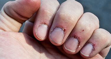 If you require a strong prescription, the process may take longer. Do Cuticles Grow Back? - Get Long Nails