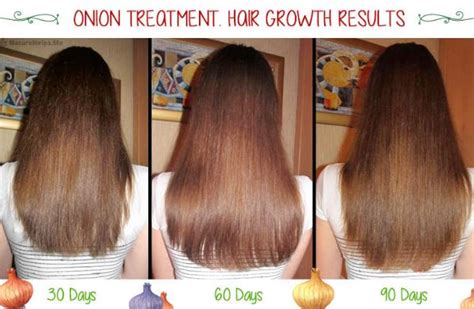 In this blog post, i have put together several stunning ways to use onion juice to boost hair using onion juice is a sure method to boosting hair growth and promoting hair regrowth. Onion Juice for Hair Growth, How to Use, Reviews, Before ...