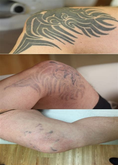 He used a method known as sal abrasion. Laser Tattoo Removal Before and After Pictures