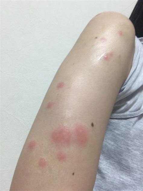 写真は、ツメダニに太ももを刺された人のものです。複数個所 ...