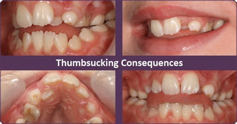 I just couldn't see myself spending 10 to 15 thousand dollars for root canals, crowns, and fillings, and taking the chance that it wouldn't help or that they would go bad on down the. Can Braces Fix Teeth Damaged By Thumb Sucking? | One ...