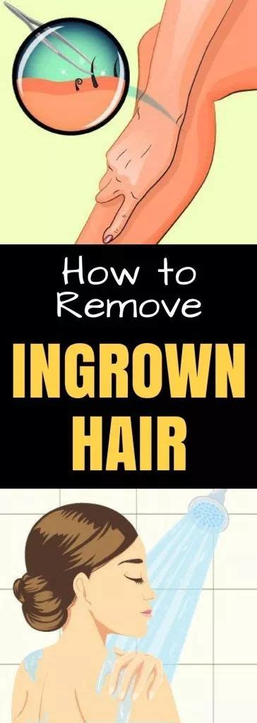 You can get deep ingrowing hairs in the pubic area, on scalp, in armpit, legs, face and even chin. How To Remove An Ingrown Hair - | Ingrown hair removal ...