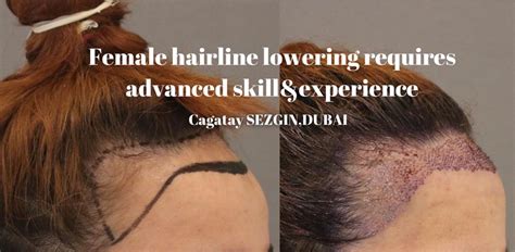 Elena suffers from genetic hair loss, which can also affect women. Genetic Female Hair Loss - Dr Cagatay Sezgin Dubai