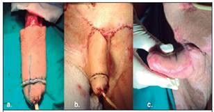 Maybe you would like to learn more about one of these? (Penile reconstruction with microsurgery)