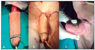 La faloplastia utiliza tejido de otras partes del cuerpo, habitualmente piel y grasa del antebrazo, para recrear un pene de dimensiones anatómicas que, una vez modelado, será transportado a su posición. (Penile reconstruction with microsurgery)