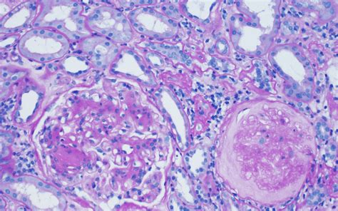 Roth d., smith r., schulman g. Renal Disease