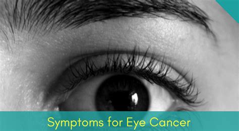 Your treatment choices depend on the type of eye cancer you have, test. 4 Categories & Symptoms of Eye Cancer You Must Know!
