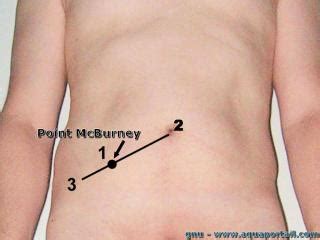 The lanz incision is made at the same point along the transverse plane and deemed cosmetically better. Signe de Mac Burney: définition