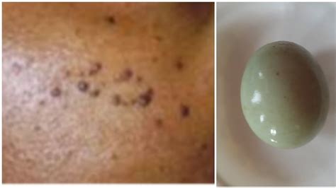 Bila lihat muka di cermin yang ada ' blackhead ', tentu seorang wanita itu rungsing. CARA CEPAT MENGHILANGKAN BINTIK HITAM SEPERTI TAHI LALAT ...