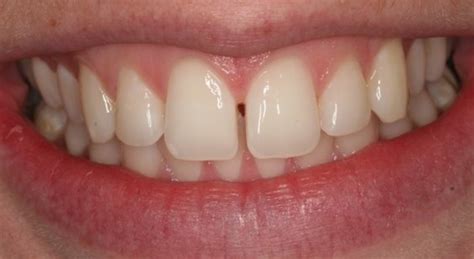 Maybe you would like to learn more about one of these? How to Fix Gaps Between Teeth - French Dental Services -Dr ...