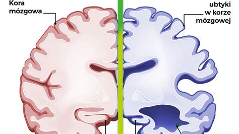 Choroba afektywna dwubiegunowa jest definiowana przez psychologię popularną lub uliczną jako częste oraz niekontrolowane huśtawki nastroju. Choroba Alzheimera: przyczyny, objawy, leczenie