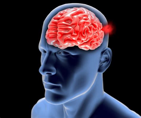 A brain aneurysm (sometimes called a cerebral aneurysm) is an abnormal bulging or aneurysms can also occur in the major head and neck vessels leading to the brain, called the carotid arteries. Brain Aneurysm - Radiology Consultants