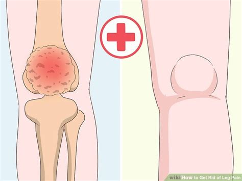 Learn how to cure braces pain using these simple yet effective home remedies. 3 Ways to Get Rid of Leg Pain - wikiHow