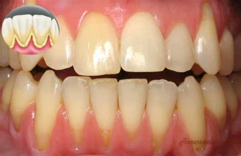 You know it's important to brush, floss, and rinse with an antiseptic no matter how good you are with a toothbrush, dental floss is the only way to remove plaque between your teeth and keep tartar out of these. 17 Simple Home Remedies for Removing Tartar and Plaque for ...