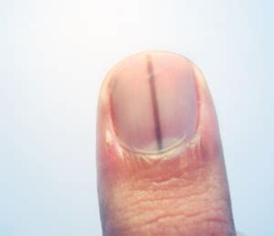 A malignant tumor in a nail nearly always affects just one nail. Pin on Healthy