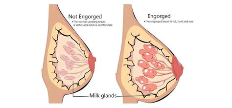 Engorged breasts This is when the... - The Natural Parent ...