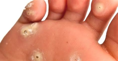 Come trattare le verruche dei piedi o delle mani ...