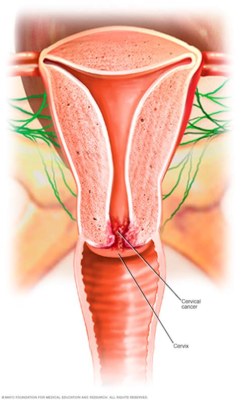 One of the most important things to recognize for women's health is that cervical cancer after menopause can be cured, so long as it is caught in the early stages. Cervical cancer Disease Reference Guide - Drugs.com