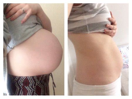 Mein bauch ist schon kleiner, aber seid dem kaiserschnitt (17.01.2010) der über den ganzen bauch bei mir geht, wegen einer not op nach dem kaiserschnitt hängt er und leider geht der einfach nicht weg. Mama's leerer Baby-Bauch - September 2014 BabyClub - Seite ...