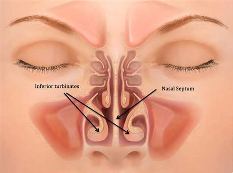 About 80 per cent of people have a deviated septum but are unaware of it. What is Nasal Septum Perforation? | New Health Advisor