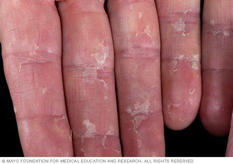 Your hands are most likely peeling from a chemical exposure or dry skin. Peeling skin - Drugs.com