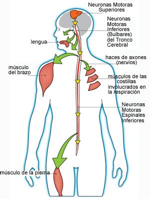 Se estima que más de la mitad de las motoneuronas se pierden antes de que comiencen a aparecer síntomas evidentes que pueden incluir. Qué es la Esclerosis lateral amiotrófica? - El Poder de Miami