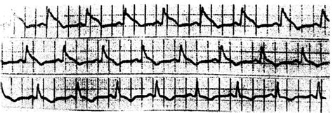 Vasospastic angina (prinzmetal angina) — definition and treatment. Prinzmetal Angina: ECG Changes and Clinical Considerations ...