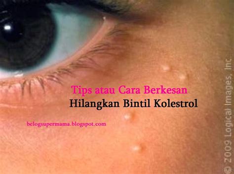 Cara hilangkan bintik merah dimuka. Cara Hilangkan Biji Kolesterol Di Muka - sanx-xox