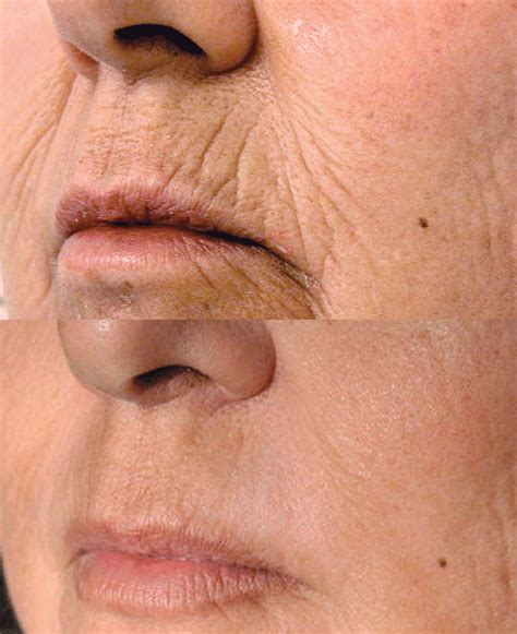 Treatments for wrinkled skin | Men's aesthetics | Medispa Physimed