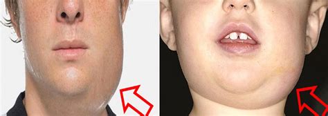 Penyakit GONDONGAN Pada Anak - Dewasa Obat dan Gejala ...