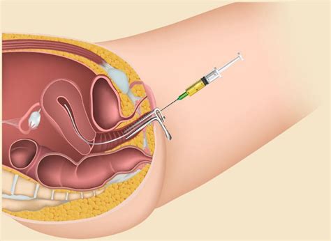 Process, sucess rate and plan for iui. What Is IUI: Procedure, Success Rates & Risks | by Marica ...