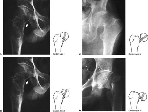 Femoral Neck Fractures - TeachMe Orthopedics