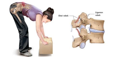 Selalu ada kemungkinan sakit pinggang yang dirasakan di sebelah kanan disebabkan oleh adanya cedera. Sakit Pinggang: Penyebab dan Cara Mengatasinya • Deherba.com