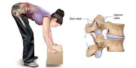 Sakit akibat otot umumnya singkat, sedangkan sakit akibat saraf dapat bertahan lama. Sakit Pinggang: Penyebab dan Cara Mengatasinya • Deherba.com