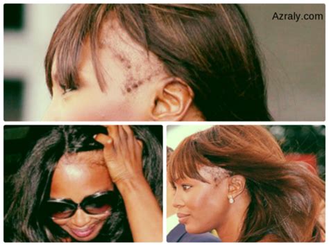 Pour pouvoir traiter la chute de cheveux féminine, il convient d'en identifier la ou les causes probables. Perte Cheveux Localisée Femme / Pelade Definition ...