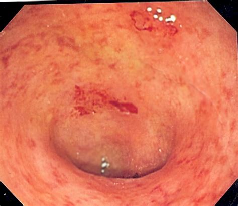 An ulcerative colitis reminds more of the cramps in the region of abdomen. Ulcerative colitis - Wikiwand