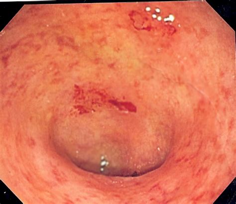 Ulcerative colitis - Wikiwand