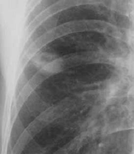 Spontaneous pneumothorax and marfanoid rigante d., segni g., bush a. Комплексная лучевая диагностика периферического рака ...