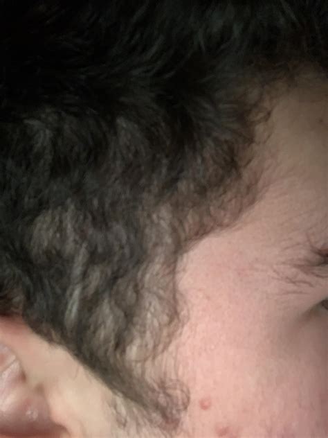 With the right care and products, you can reverse hormonal hair. Hair thinning after 2 months... Is this from Accutane ...