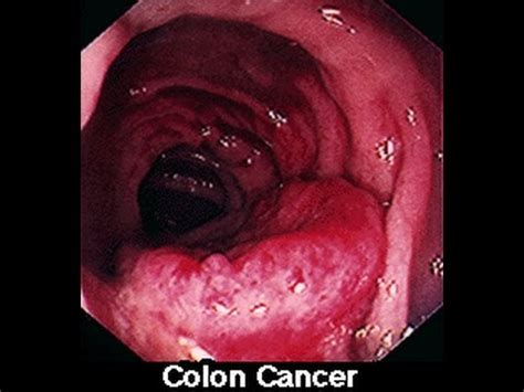 Most people are familiar with their normal bowel patterns and habits. Symptoms of Colon Colorectal Cancer in Men & Women - YouTube