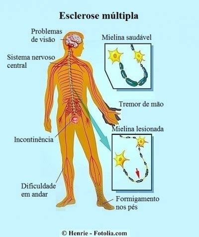 Multiple sclerosis (ms) is a chronic. Esclerose múltipla, sintomas e causas, tipos, complicações ...