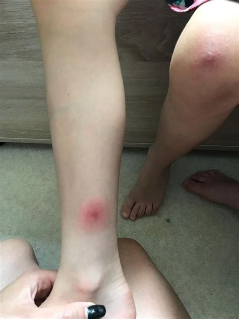 This is to prevent infection which will be infinitely worse than the bite. Mum ends up in A&E after false widow spider bites her on ...