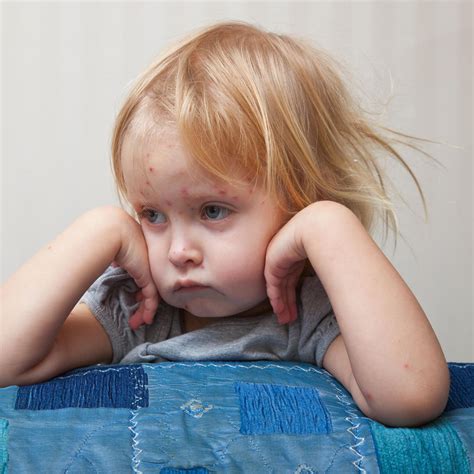 Die betroffenen hautstellen entsprechen den nervenbahnen, an denen das virus nach seiner reaktivierung entlang wandert. 29 Best Photos Windpocken Wann Wieder Kindergarten ...