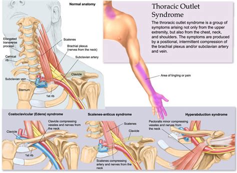 Thoracic outlet syndrome (tos) refers to a constellation of signs and symptoms that arise from compression of the neurovascular bundle by various structures in. Thoracic Outlet Syndrome - Symptoms, Causes and Treatment ...