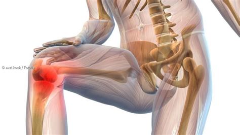 Genaue diagnostik und multimodale behandlung bei rückenschmerzen, nackenschmerzen, kniebeschwerden, sehnenbeschwerden und arthrose. ᐅ Akupunktur bei Arthrose - Kniepatienten atmen auf