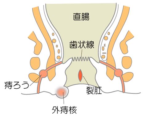 疾患について｜宮崎市の一般内科・肛門外科・胃腸内科｜宮崎 ...